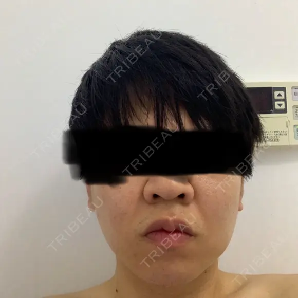 糸リフト / バッカルファット除去 / 脂肪吸引（顔） / ジョールファット除去 / 脂肪吸引注射（顔） SEA CLINIC（シークリニック） AFTER メイン用