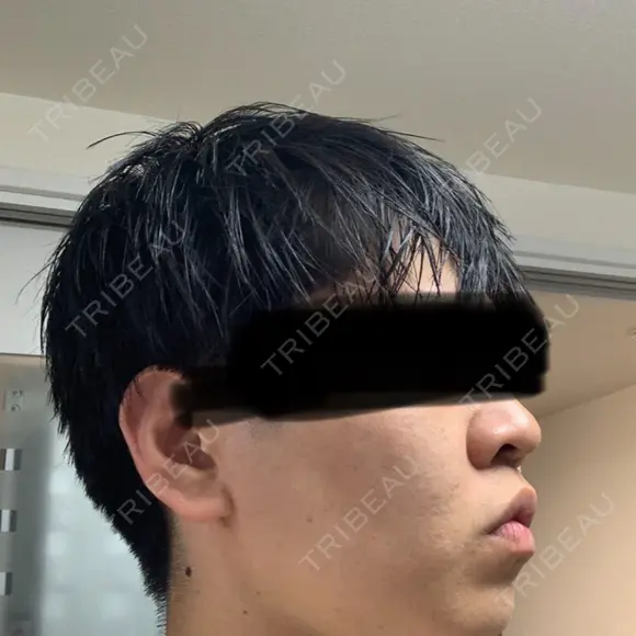 糸リフト / バッカルファット除去 / 脂肪吸引（顔） / ジョールファット除去 / 脂肪吸引注射（顔） SEA CLINIC（シークリニック） DAY 166 メイン用