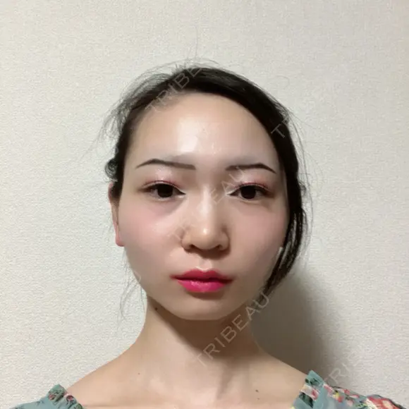 鼻尖形成（切開） / 小鼻縮小（切開） / 軟骨移植 / 鼻尖縮小 / 鼻孔縁下降 アリエル美容クリニック 郡山院 DAY 35 メイン用