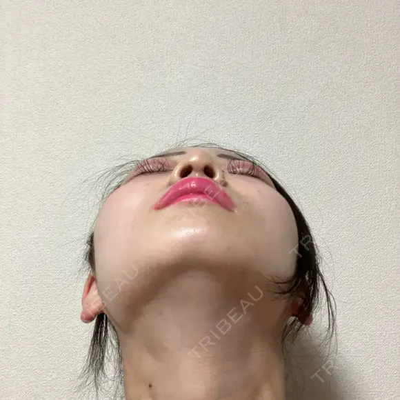 鼻尖形成（切開） / 小鼻縮小（切開） / 軟骨移植 / 鼻尖縮小 / 鼻孔縁下降 アリエル美容クリニック 郡山院 DAY 35 メイン用