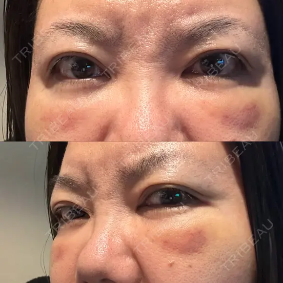 クマ治療 PRISM Beauty Clinic 町田院 DAY 8 メイン用