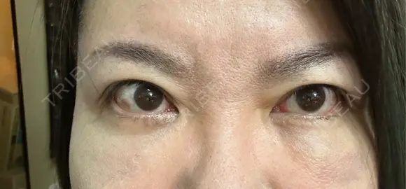 クマ治療 PRISM Beauty Clinic 町田院 DAY 8 メイン用