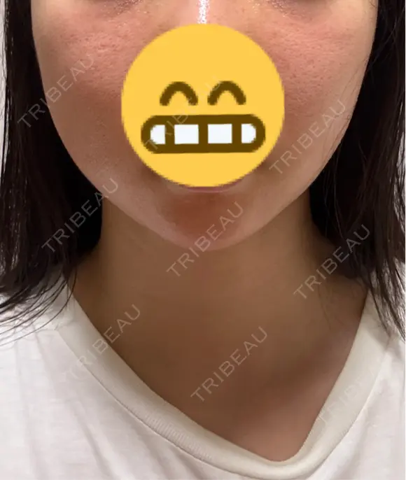 脂肪吸引（顔） / ジョールファット除去 / ボトックス（あご） / ヒアルロン酸注入（あご） / ボトックス（首） WOM CLINIC GINZA （ワム クリニック ギンザ） AFTER メイン用