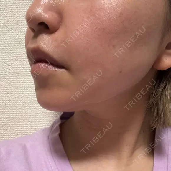 鼻翼基部形成（貴族手術） eクリニック 名古屋院 DAY 10 メイン用