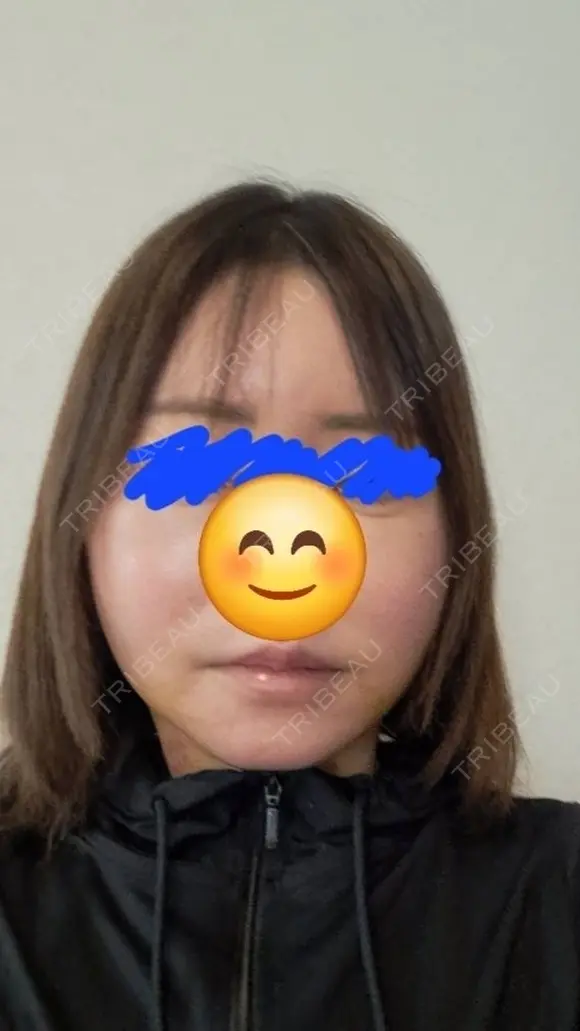 その他（輪郭） / ボトックス（エラ・小顔） / ボトックス（額） WOM CLINIC GINZA （ワム クリニック ギンザ） DAY 7 メイン用