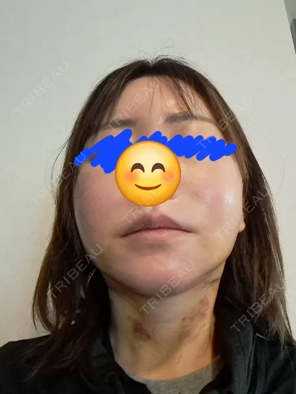 その他（輪郭） / ボトックス（エラ・小顔） / ボトックス（額） WOM CLINIC GINZA （ワム クリニック ギンザ） DAY 7 メイン用