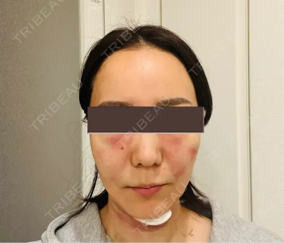 糸リフト / 脂肪吸引（顔） / メーラーファット除去 / 脂肪吸引注射（顔） SEA CLINIC（シークリニック） AFTER メイン用