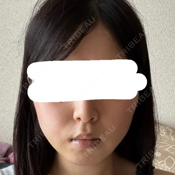 糸リフト / バッカルファット除去 / 脂肪吸引（顔） / ネックリフト / ヒアルロン酸注入（あご） / ボトックス（エラ・小顔） / ヒアルロン酸注入（唇） / ヒアルロン酸注入（鼻翼基部） / ヒアルロン酸注入（ほうれい線） HAAB×DREAM BEAUTY CLINIC 東京本院 DAY 10 メイン用
