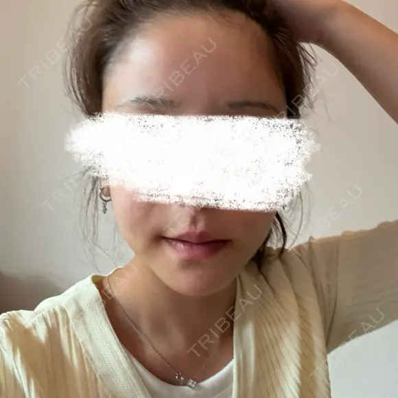 脂肪注入（額） 4Dクリニック AFTER メイン用