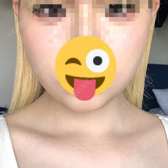 糸リフト / 脂肪吸引（顔） / ボトックス（エラ・小顔） PRISM Beauty Clinic 町田院 AFTER メイン用