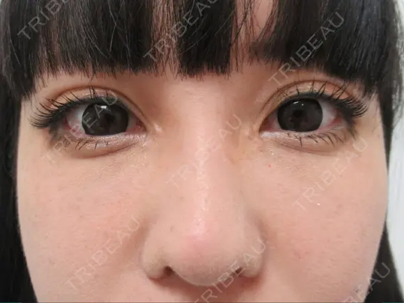 二重埋没 / 目頭切開 / 小鼻縮小（切開） / 糸リフト / 人中短縮 / タレ目形成・グラマラスライン（切開） / 鼻尖縮小 / ヒアルロン酸注入（鼻） / ヒアルロン酸注入（あご） / ヒアルロン酸注入（唇） / ピーリング（ニキビ・毛穴） / イオン導入 / 美肌レーザー / 美白レーザー 銀座TAクリニック DAY 32 メイン用