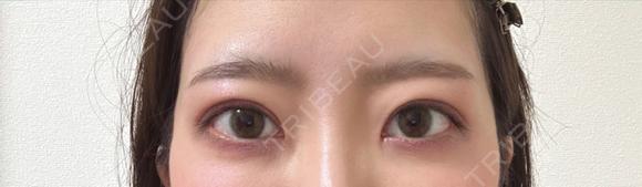 二重切開 / 目頭切開 / 眼瞼下垂（切開） LUHO（ルホ）美容外科 AFTER メイン用