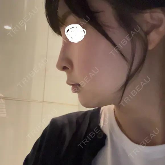 ヒアルロン酸溶解 EOL CLINIC【オルクリニック】 DAY 0 メイン用