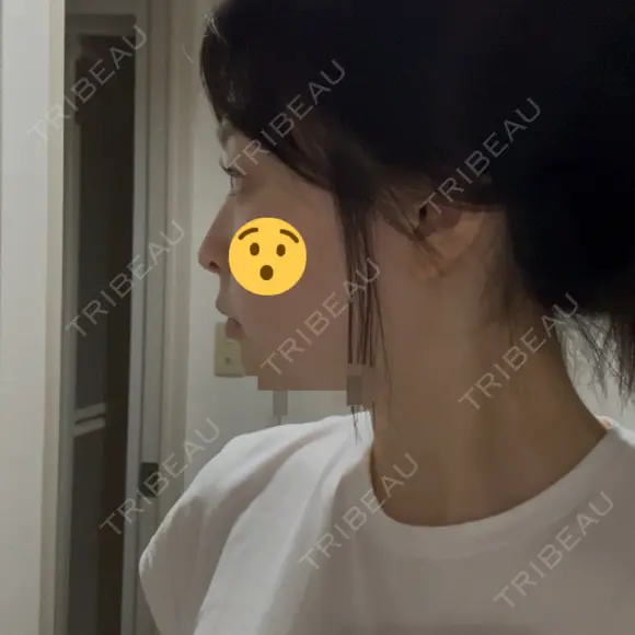 ヒアルロン酸溶解 EOL CLINIC【オルクリニック】 DAY 1 メイン用
