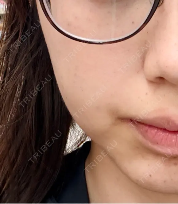 水光注射（ハリ・美肌） メディアージュクリニック 大阪梅田院 DAY 1 メイン用