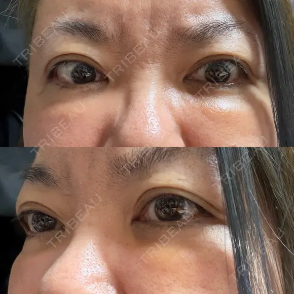 クマ治療 PRISM Beauty Clinic 町田院 DAY 17 メイン用