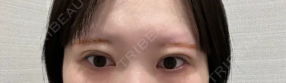 二重埋没 R Beauty CLINIC 名古屋院 AFTER メイン用
