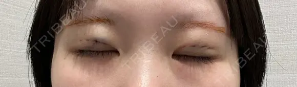 二重埋没 R Beauty CLINIC 名古屋院 DAY 0 メイン用