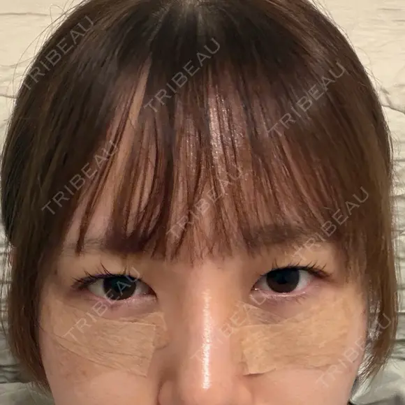下まぶたの脂肪取り 聖心美容クリニック 福岡院 DAY 0 メイン用