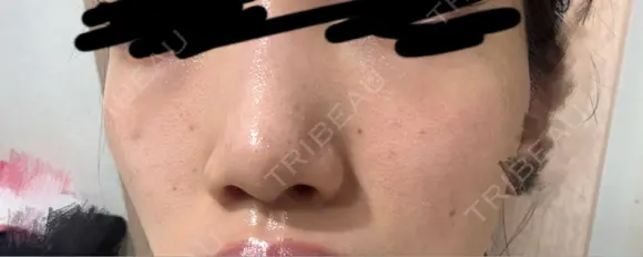 肌育注射（ジュベルックなど） Natural Skin Clinic 自由ヶ丘院 AFTER メイン用
