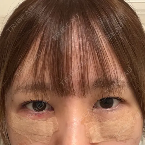 下まぶたの脂肪取り 聖心美容クリニック 福岡院 DAY 1 メイン用