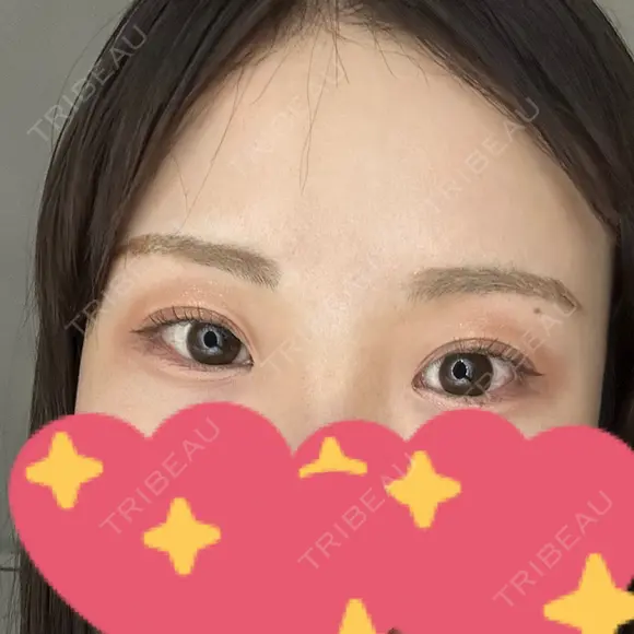二重埋没 / 眼瞼下垂（非切開） OMI CLINIC 【オミクリニック】 AFTER メイン用