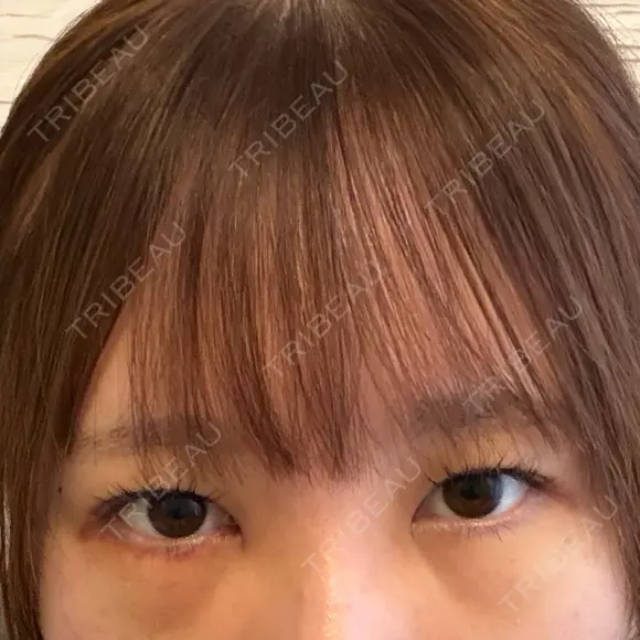 下まぶたの脂肪取り 聖心美容クリニック 福岡院 DAY 2 メイン用