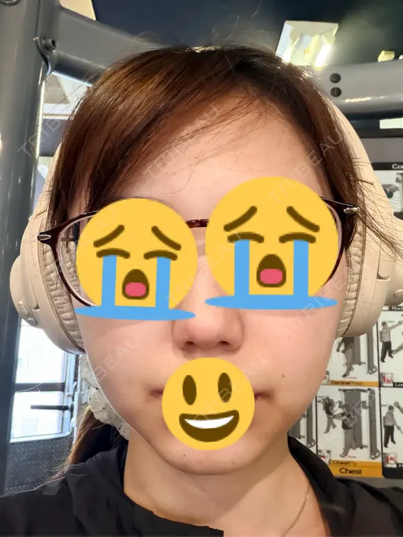 水光注射（ハリ・美肌） メディアージュクリニック 大阪梅田院 DAY 3 メイン用