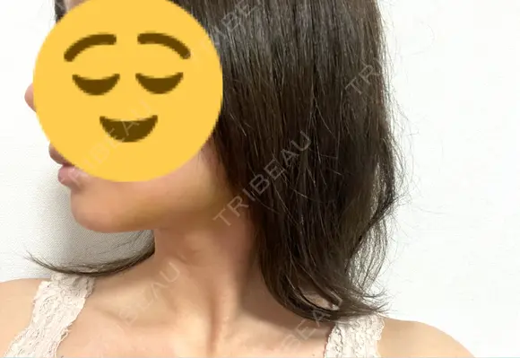 糸リフト / クマ治療 / 脂肪吸引（顔） / 下まぶたの脂肪取り / 脂肪注入（目の下） / ヒアルロン酸注入（あご） 藤・ナチュレ美容クリニック 銀座院 DAY 4 メイン用