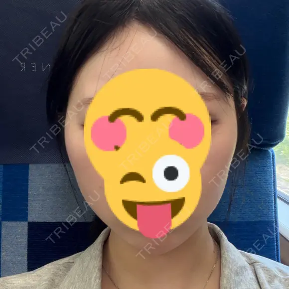 脂肪吸引（顔） / ボトックス（エラ・小顔） WOM CLINIC GINZA （ワム クリニック ギンザ） AFTER メイン用