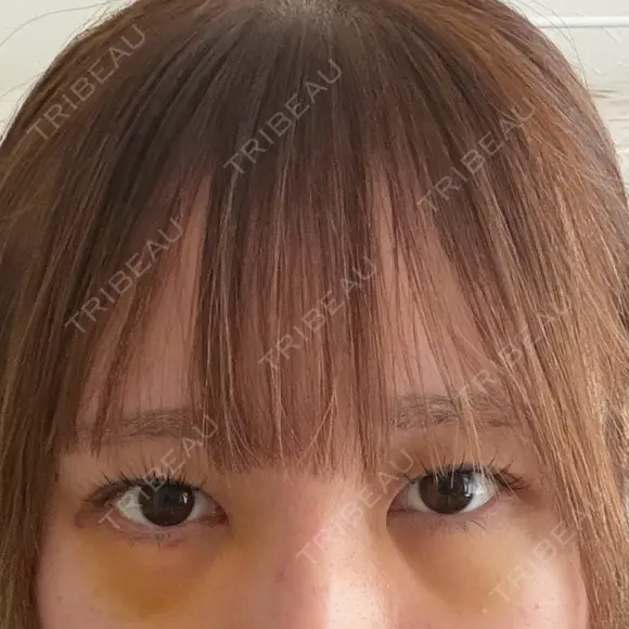 下まぶたの脂肪取り 聖心美容クリニック 福岡院 DAY 4 メイン用