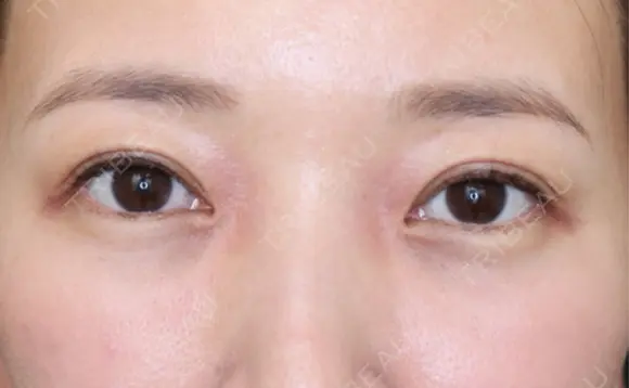 眼瞼下垂（切開） / 下まぶたたるみ取り WOM CLINIC GINZA （ワム クリニック ギンザ） AFTER メイン用