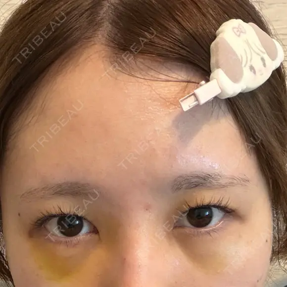 下まぶたの脂肪取り 聖心美容クリニック 福岡院 DAY 5 メイン用