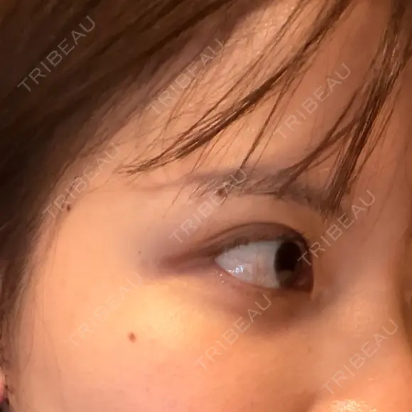 二重埋没 水の森美容クリニック 横浜院 DAY 43 メイン用