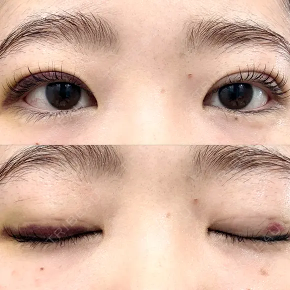 二重埋没 湘南美容クリニック 博多院 DAY 8 メイン用