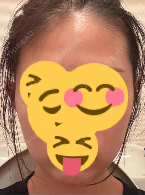 ピーリング（ニキビ・毛穴） EME CLINIC AFTER メイン用