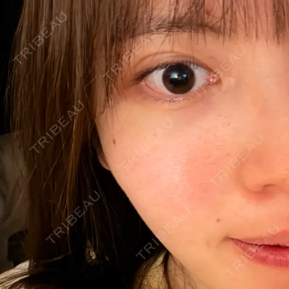 二重埋没 水の森美容クリニック 横浜院 AFTER メイン用
