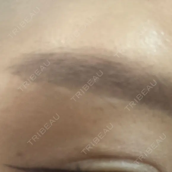 眉下切開 PRO CLINIC プロクリニック 銀座院 DAY 402 メイン用