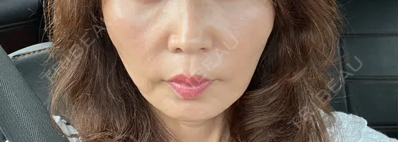 糸リフト / ヒアルロン酸注入（頬） / ヒアルロン酸注入（こめかみ） ルラ美容クリニック 新潟院 DAY 2 メイン用