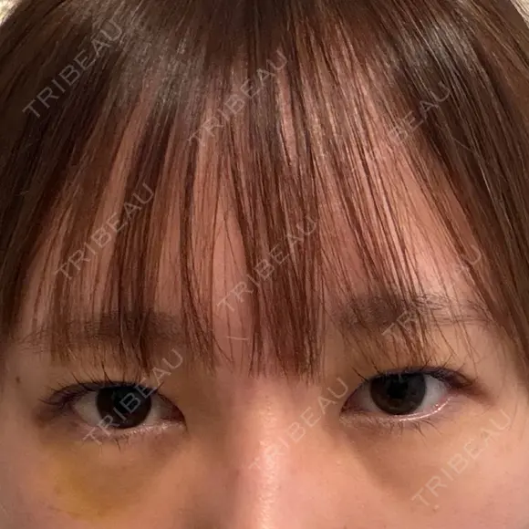 下まぶたの脂肪取り 聖心美容クリニック 福岡院 AFTER メイン用