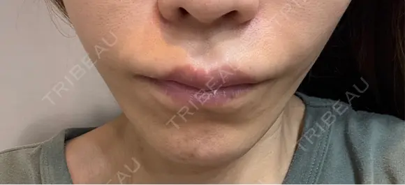 切開リフト GRACY TOKYO CLINIC【グレイシートウキョウクリニック】 DAY 0 メイン用