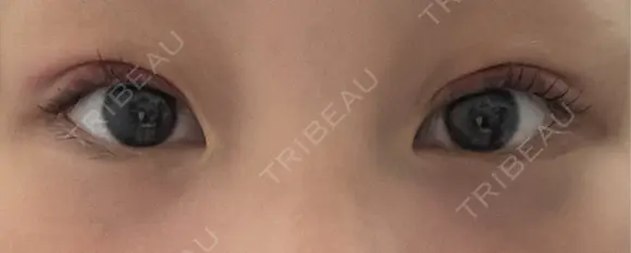 二重埋没 HAAB×DREAM BEAUTY CLINIC 大阪梅田院 DAY 7 メイン用