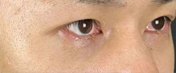 クマ治療 藤・ナチュレ美容クリニック 銀座院 DAY 0 メイン用