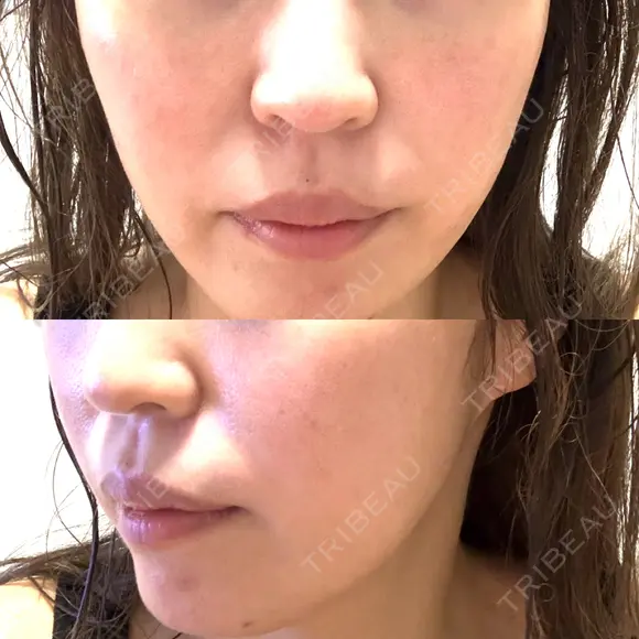 RF（高周波）たるみ治療 / オリジオ muni skin clinic AFTER メイン用