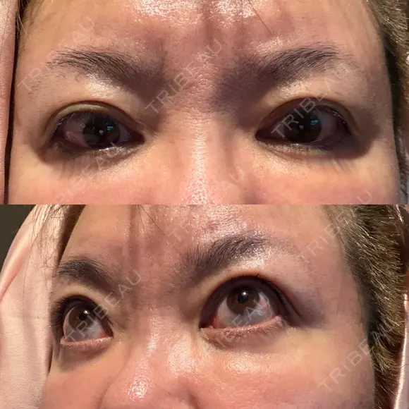 クマ治療 PRISM Beauty Clinic 町田院 DAY 26 メイン用