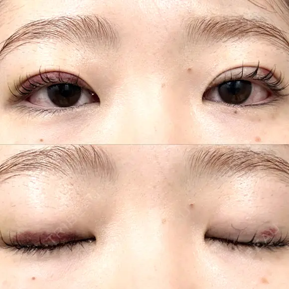 二重埋没 湘南美容クリニック 博多院 DAY 12 メイン用