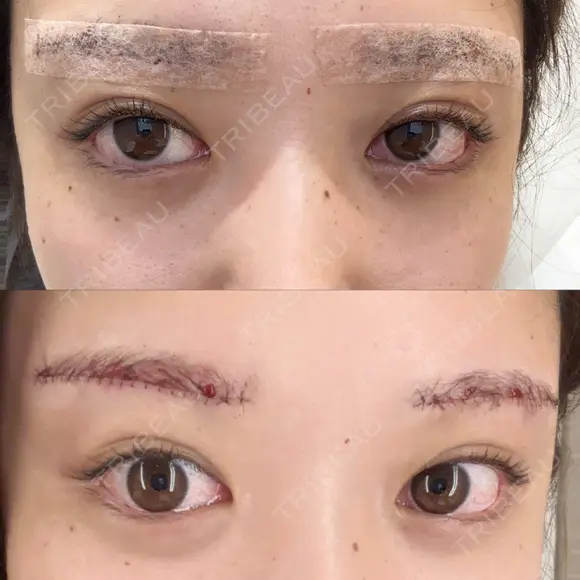 下まぶたの脂肪取り / 眉下切開 / ボトックス（額） 表参道ウィズ・クリニック DAY 0 メイン用