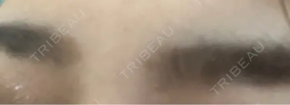 ボトックス（額） 品川美容外科 梅田院 DAY 13 メイン用