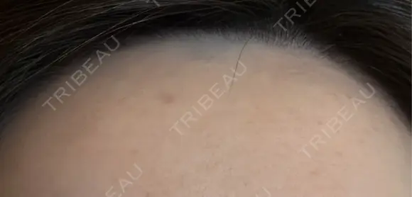 医療脱毛（顔） Jスキンクリニック 【J-SKIN clinic】 AFTER メイン用
