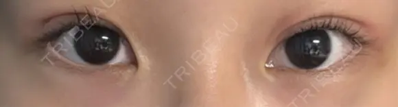 二重埋没 HAAB×DREAM BEAUTY CLINIC 大阪梅田院 AFTER メイン用